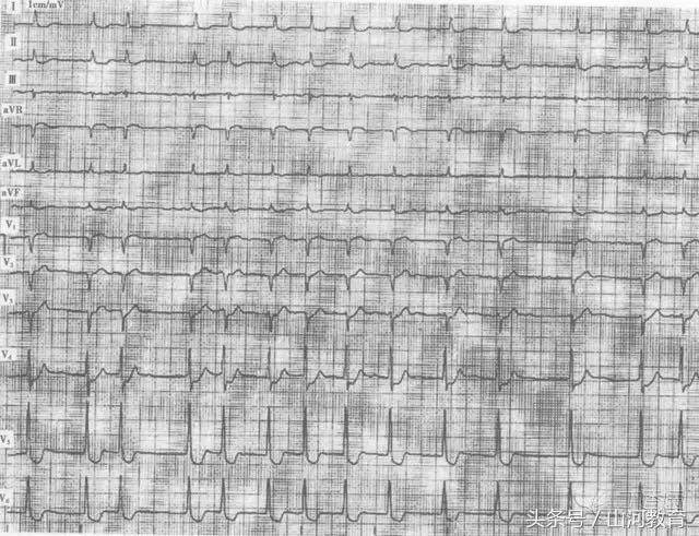 图 1 一例典型的洋地黄型 st 鱼钩样改变 洋地黄中毒易出现何种心律