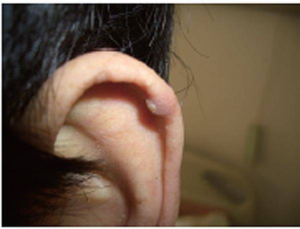 通常是多关节分布,好发于外耳的耳轮处.