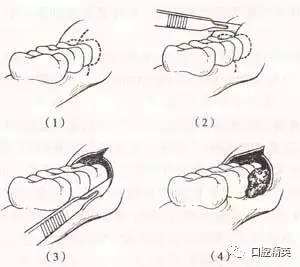 下颌第三磨牙冠周炎-病因-临床表现