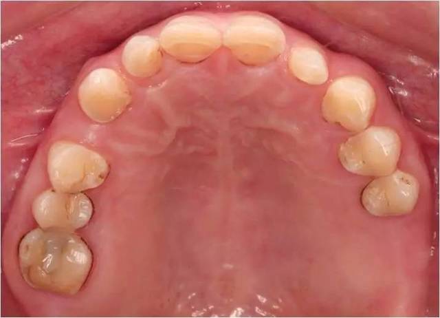 初步诊断 ①上颌牙列缺损;② 前牙散在间隙;③ 牙列重度磨耗.