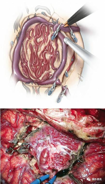 动静脉畸形切除手术的操作技巧| the neurosurgical atlas全文翻译