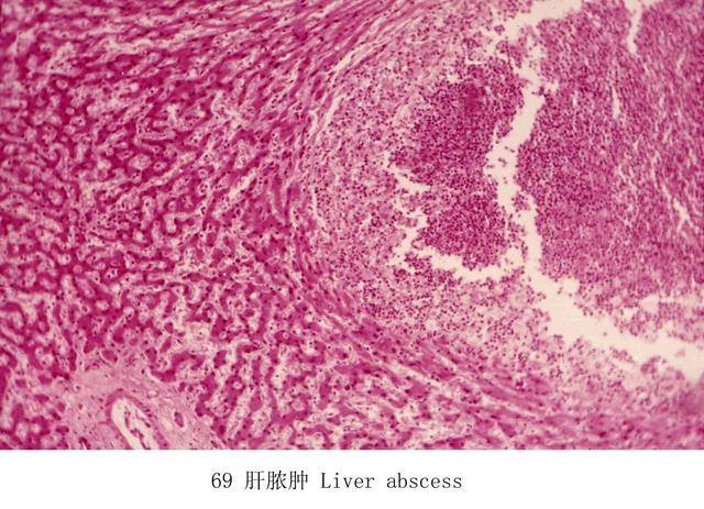 细菌性肝脓肿 阿米巴肝脓肿 真菌性肝脓肿 病史 常继发于胆道感染或