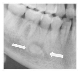 在牙的根尖周部位有一个边界清楚的致密团块,与前面介绍的特发性骨