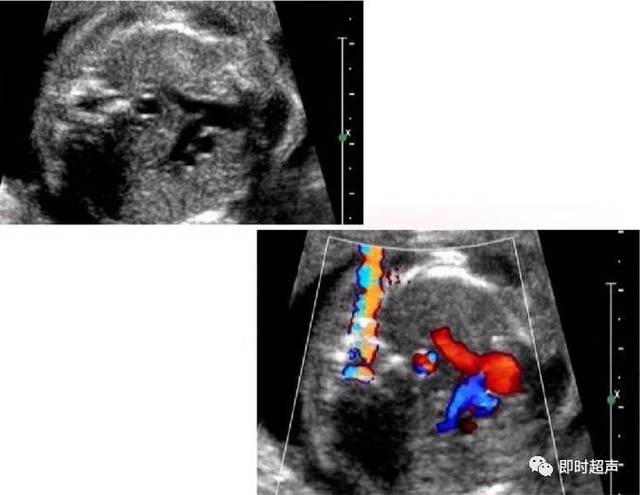 胎儿心脏检查常见切面图