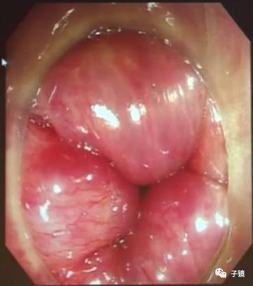 《肠镜下痔疮的治疗》学习笔记