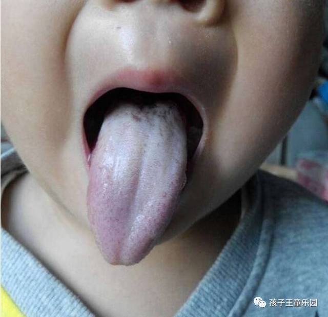 宝宝的舌头好吓人!这是生什么病了?