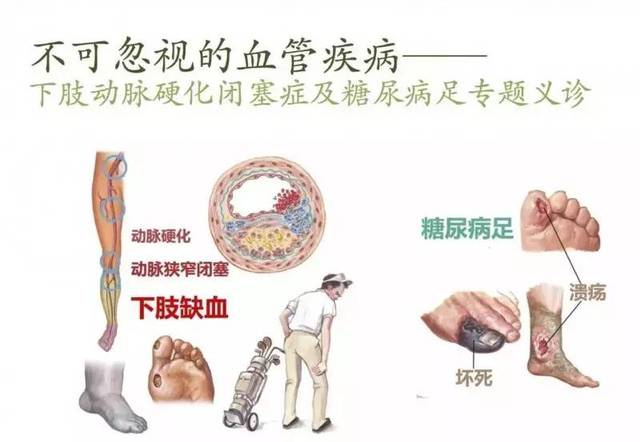 【义诊通知】糖尿病足及下肢动脉硬化闭塞症专题义诊