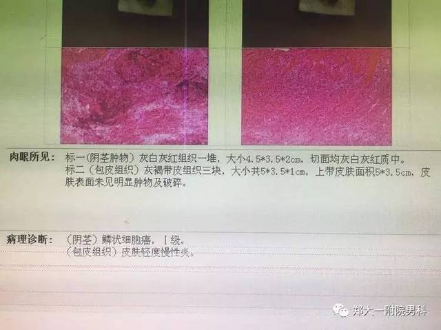 腹腔镜下腹股沟淋巴结清扫术