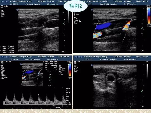 颈动脉及椎动脉超声诊断