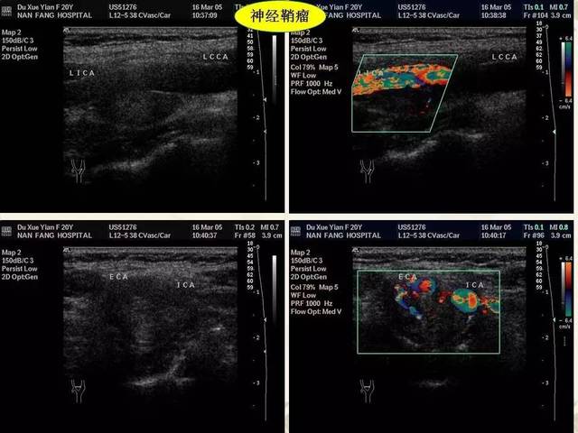 颈动脉及椎动脉超声诊断