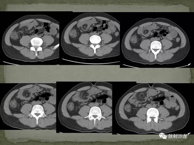 课程学习 | 肠梗阻的ct影像诊断