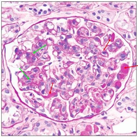 肾内病理图解:有形结构沉积肾小球病