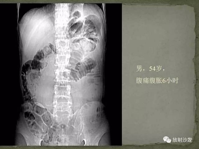 课程学习 | 肠梗阻的ct影像诊断