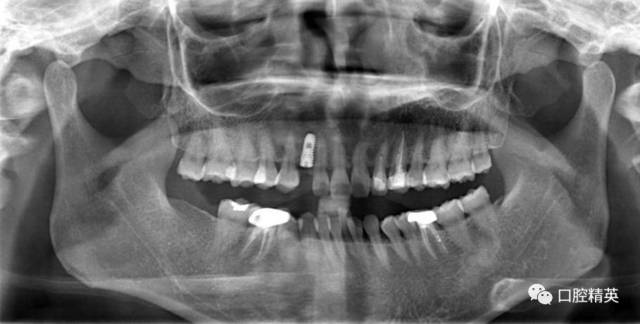 上前牙即刻种植病例一例