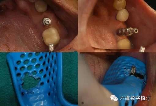 下面几张图是开窗取模"open tray"的过程 第一步,使用螺丝刀将愈合帽