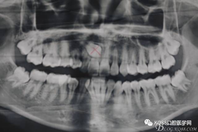 图2.患者的口内像;腭侧黏膜轻度隆起,12与14之间有邻接关系