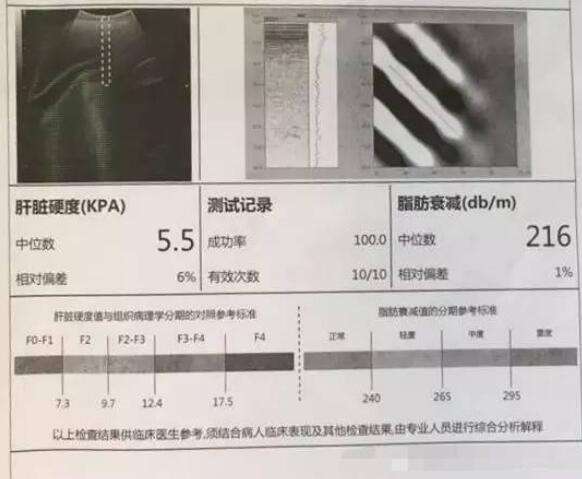 肝纤维化f2是什么?