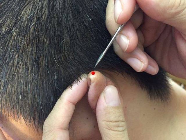 同时用刺血笔,耳尖放血也可以治疗偏头痛.