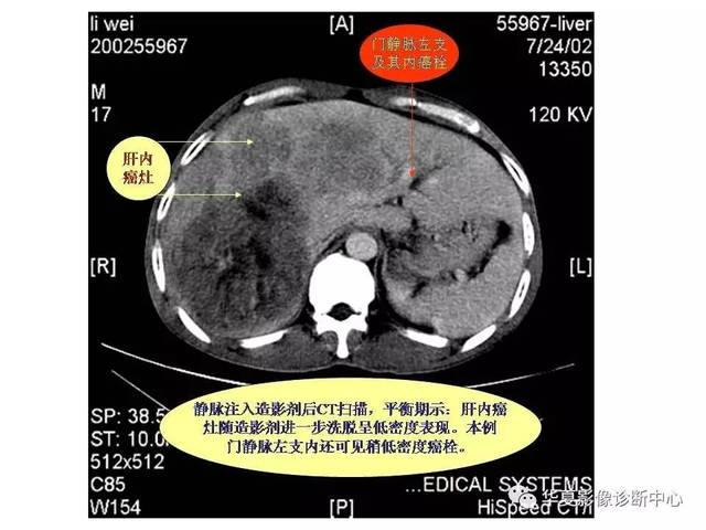 手把手教你看腹部ct