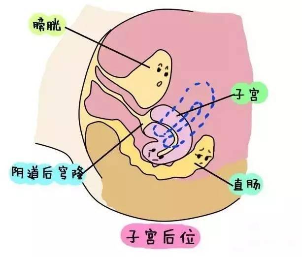 而子宫后位是指子宫体倒向直肠的方向.