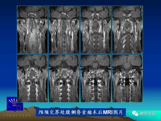 病例分享| 王国良教授:颅颈交界处腹侧脊索瘤的手术治疗策略