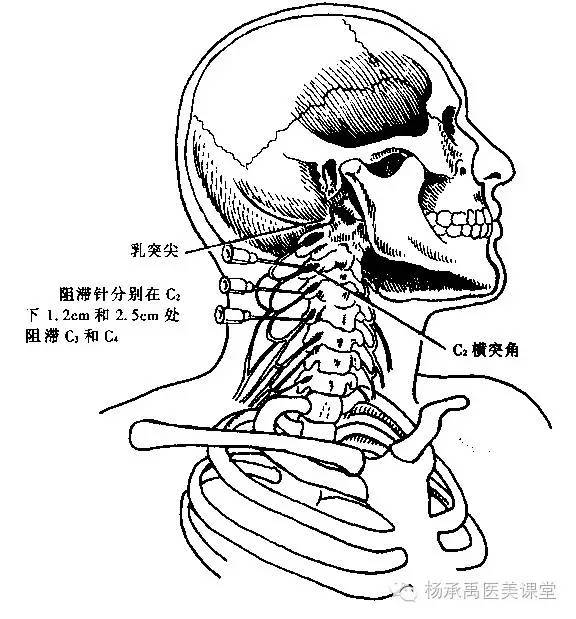 注意:从乳突分别到c2,c3,c4的绝对距离应根据颈的长短而不同.