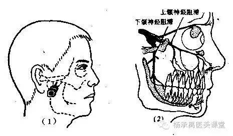 5) 下颌神经阻滞