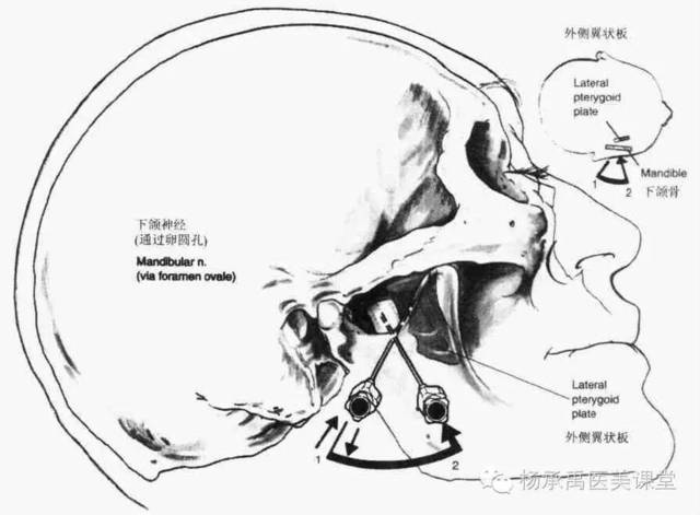 6) 耳颞神经阻滞