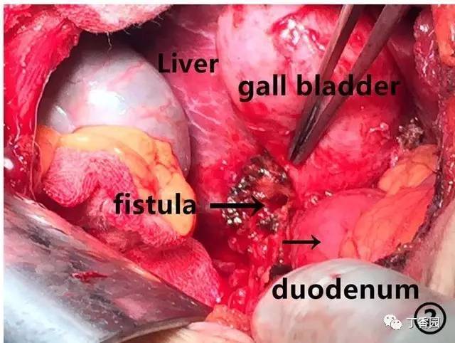 图 2. 十二指肠与胆囊旁肝脏紧密相连, 其间窦道形成. 图 3.