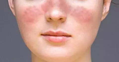 多数患者的面部会出现蝶形红斑,因此得名