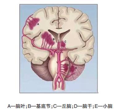 自发性脑出血的部位 脑出血的常见部位为基底节区(壳核,尾状核,丘脑)