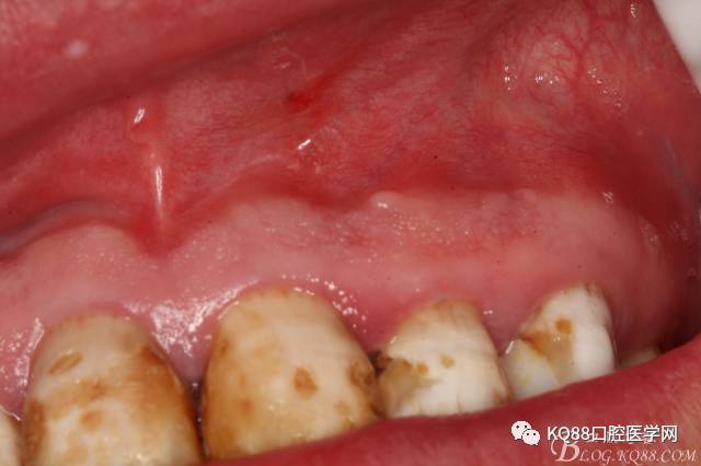 囊肿术前的口内检查:21,22牙冠未变色,唇侧粘膜色泽正常,无瘘管,可在