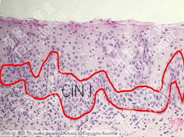 显微镜下的宫颈cin病变:风险程度高的癌前病变