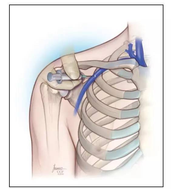 该建议证据基于与颈内或股静脉位置相比,锁骨下中心静脉导管(cvc)的