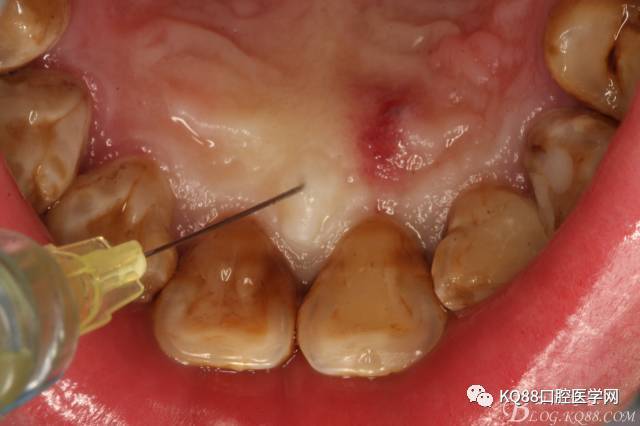 囊肿术前的口内检查:21,22牙冠未变色,唇侧粘膜色泽正常,无瘘管,可在