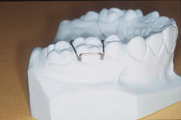 取一段钢丝沿前牙唇面弯制弧形,其位于牙冠中1/3,两端于尖牙颊面近中1