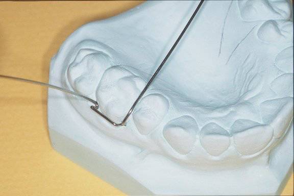 取一段钢丝沿前牙唇面弯制弧形,其位于牙冠中1/3,两端于尖牙颊面近中1