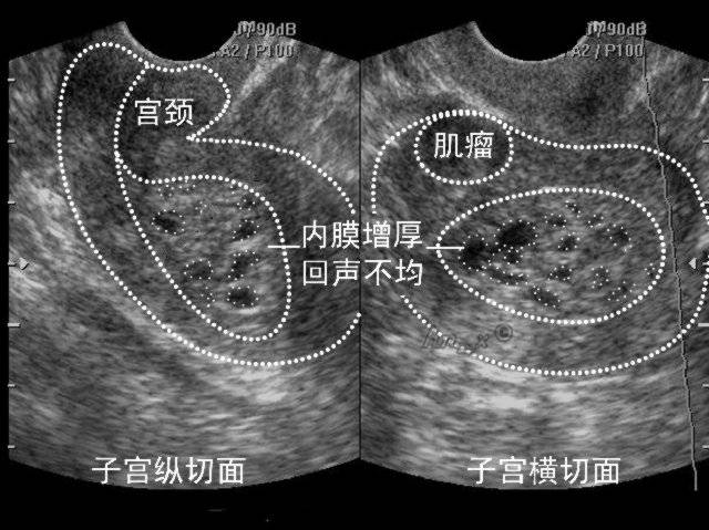 1,单纯型增生:发展为子宫内膜癌的几率仅约1%; 2,复杂型增生:发展为