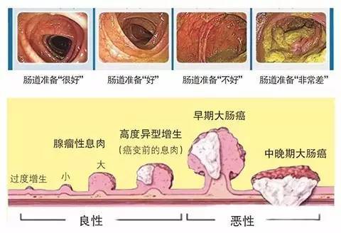 以上人群接收肠镜检查的比例不足15%,而50岁以上是大肠息肉的高发年龄