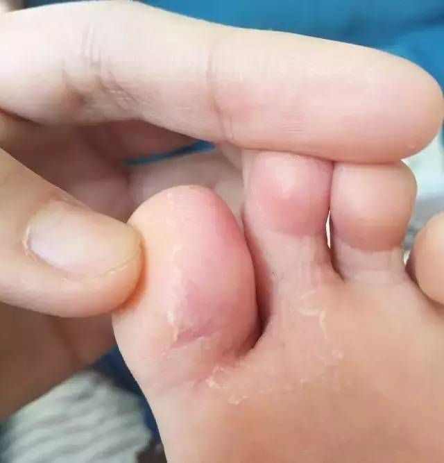 孩子脚上的湿疹最容易被误诊!
