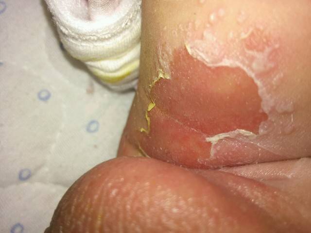 宝宝大腿肚内侧和腋下红和破皮该怎么办?