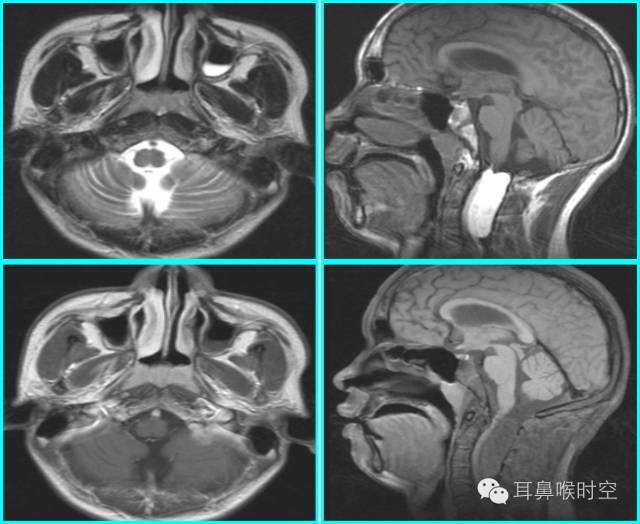 深度解析丨儿童腺样体肥大影像表现及诊断标准