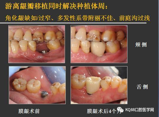 1. 游离龈瓣移植术 i. 游离龈瓣的获取及供瓣区的处理技巧; ii.