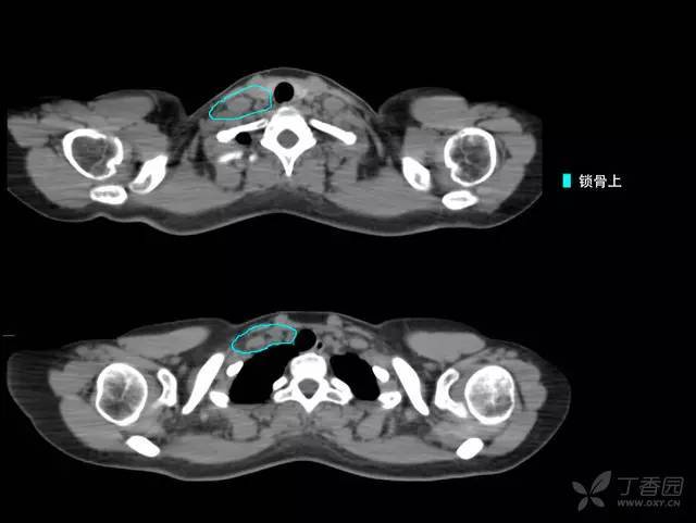 病例 2:右侧乳腺癌术后 t2n2(4/18)m0 iiia 期(下图仅显示锁骨上 ctv