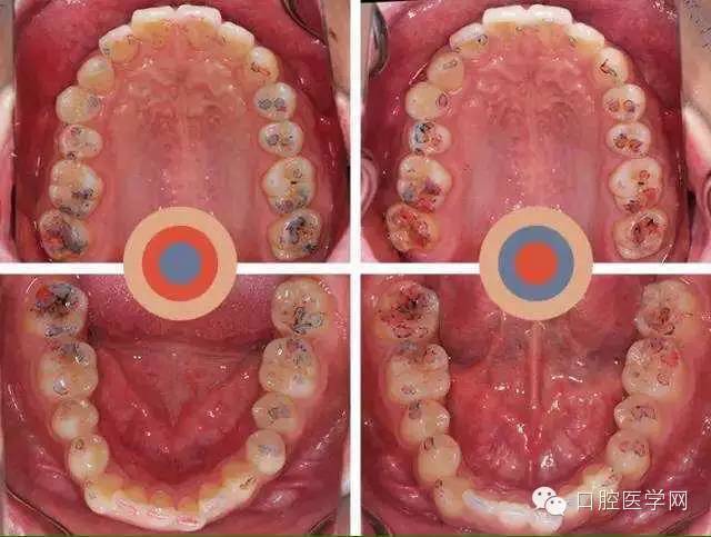 牙科咬合纸的用法_手机搜狐网