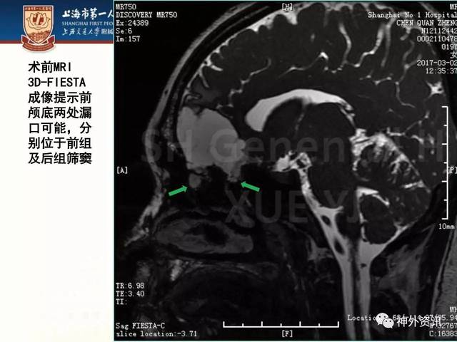 擅长(一)经鼻内镜手术,包括垂体瘤,颅咽管瘤等鞍区肿瘤切除术,经鼻视