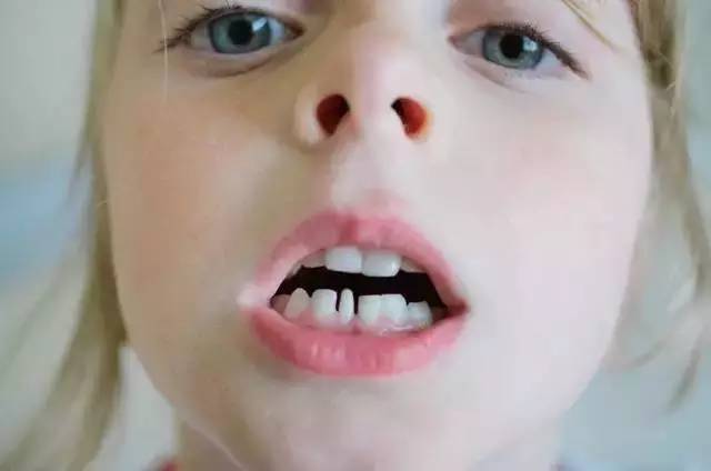 孩子的乳恒磨牙更容易患龋齿病,因为乳牙与恒牙共存,作为体积大,咬合