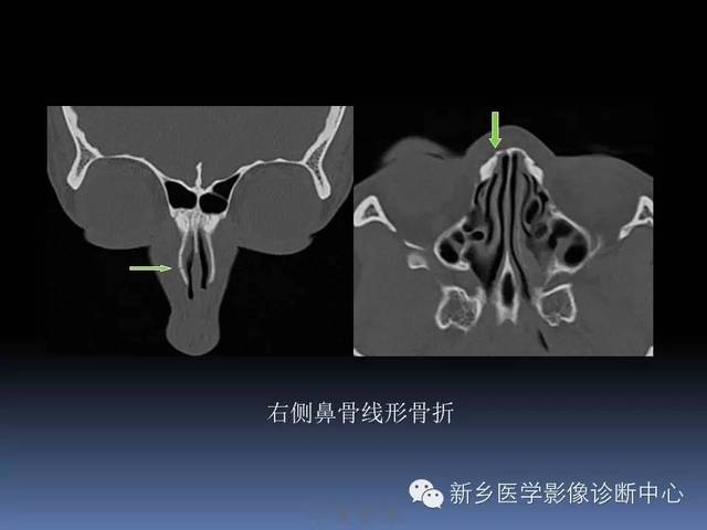 你能分清楚鼻骨骨折,鼻骨孔和鼻骨周围的缝隙吗?