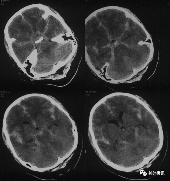 病理征阴性,脑膜刺激征阳性. 出血当日ct(2017-03-20): 基底