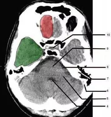 为额叶(frontal lobe)2,延髓(medulla oblongata)1,蝶窦(sphenoid